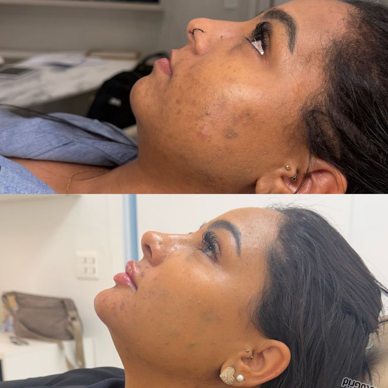 Antes e depois de perfil: nariz, lábios e queixo