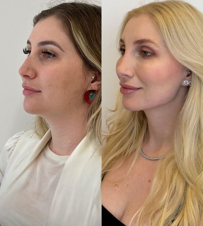Antes e depois de perfil