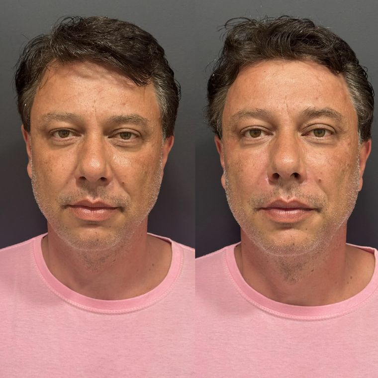 Antes e depois de frente